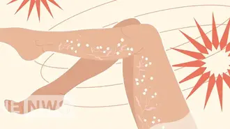 Що таке варикоз, звідки береться варикоз і як лікувати варикозне розширення вен