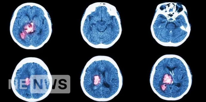 Ознаки інсульту та що таке інсульту