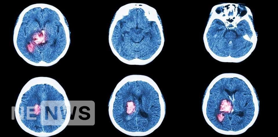 Ознаки інсульту та що таке інсульту