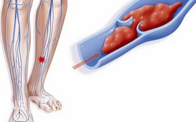 Що таке тромб? Ознаки того, що в організмі можуть бути тромби