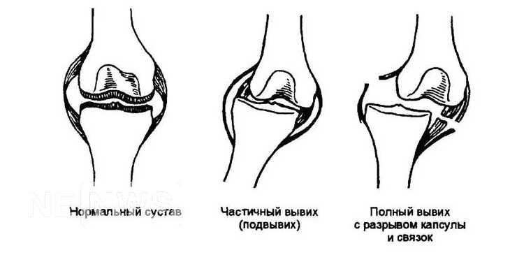 Вивих це