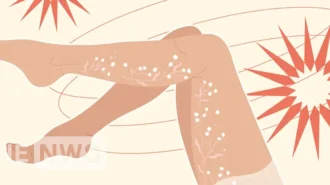 Що таке варикоз, звідки береться варикоз і як лікувати варикозне розширення вен