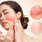 What Is Rosacea? Causes, Symptoms and Treatment