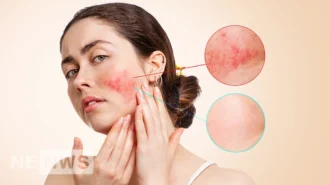 What is rosacea? What are the causes and symptoms of rosacea?