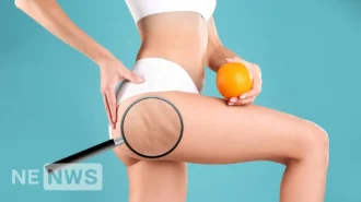 Чому зʼявляється целюліт та як його позбутися: корисні вправи від целюліту